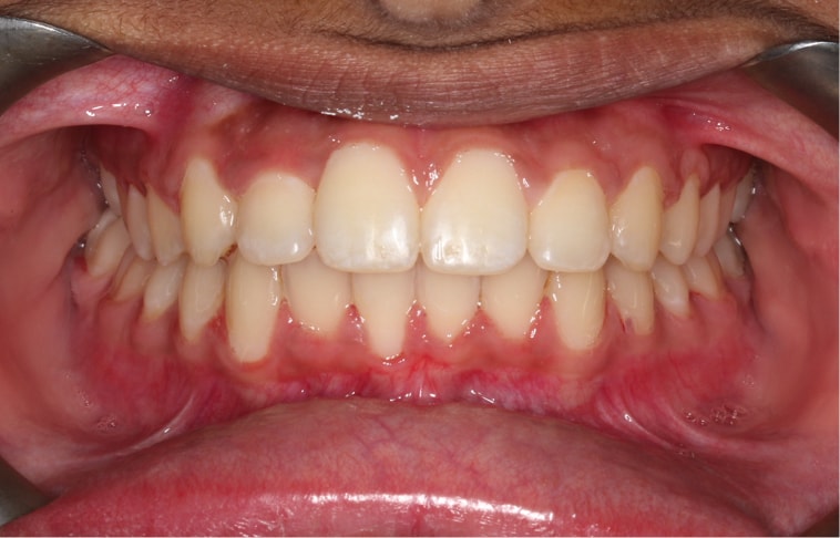 Orthodontic Treatment After Carriere Appliance