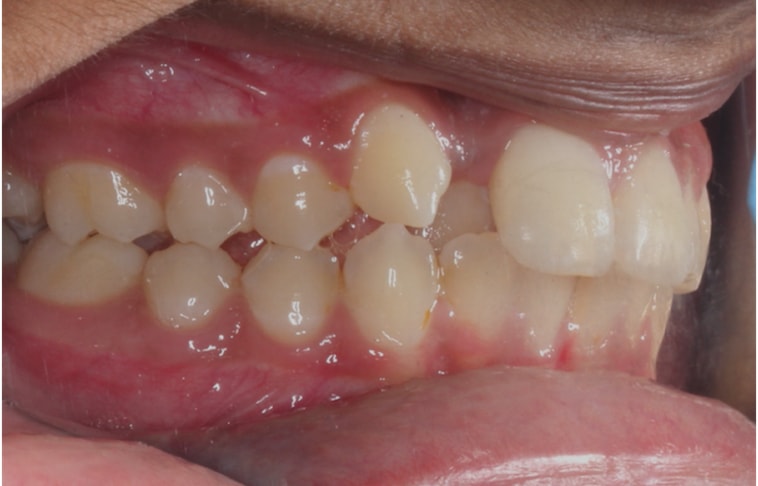 Orthodontic Treatment Before With Carriere Appliance
