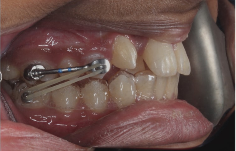 Orthodontic Treatment With Carriere Appliance