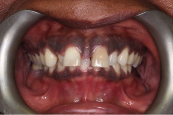 Spacing Due To Undersized and Misshaped Teeth