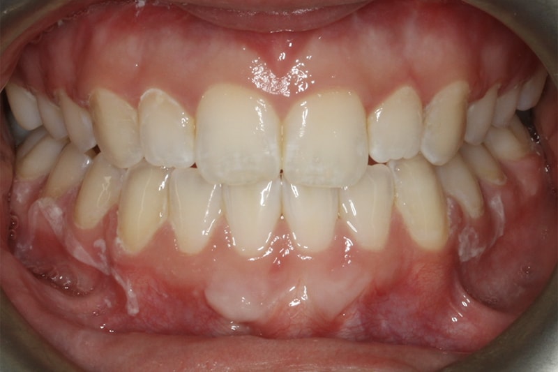 invisalign after surgery Southern Smiles Orthodontics