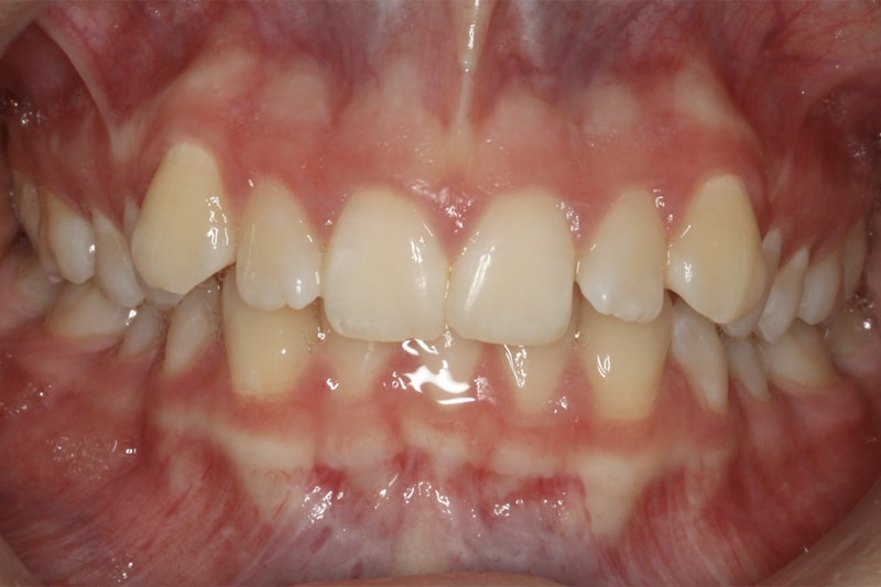 missing lower incisor initial