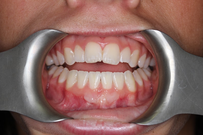 open bite and invisalign before surgery